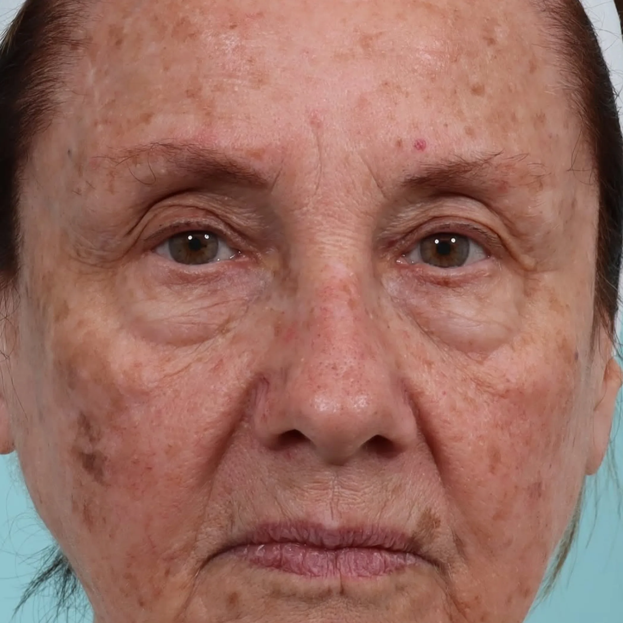 clinical portrait showing pigmentation and vascular concerns